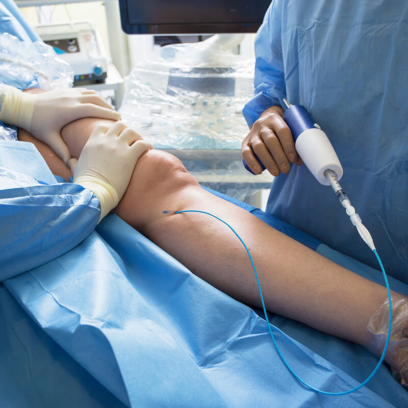 Varicose Vein Procedure