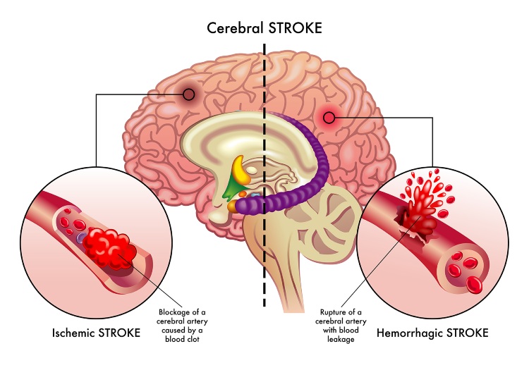 Cerebral stroke illustration infographic