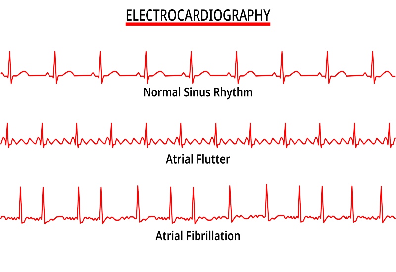 Atrial flutter and fibrillation guide by Cardiovascular Specialists of New England