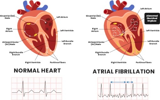 Types of atrial fibrillation explained Cardiovascular Specialists of New England