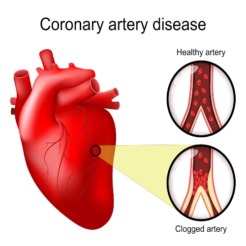 Coronary artery disease diagnosis and treatment planning at Cardiovascular Specialists of New England using advanced cardiac imaging