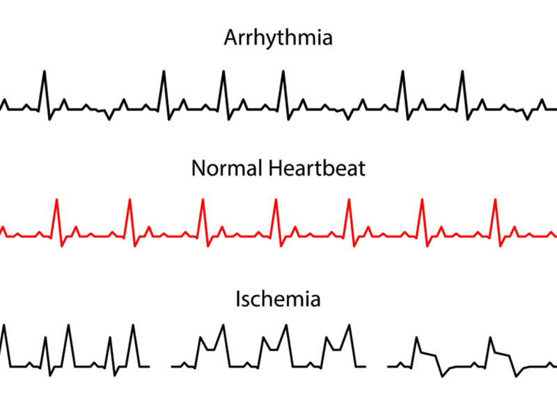 ECG chart showing arrhythmia, normal heartbeat, and ischemia